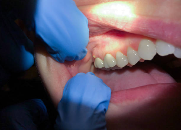 Best Dental Abscess Treatment in Fredonia, KS