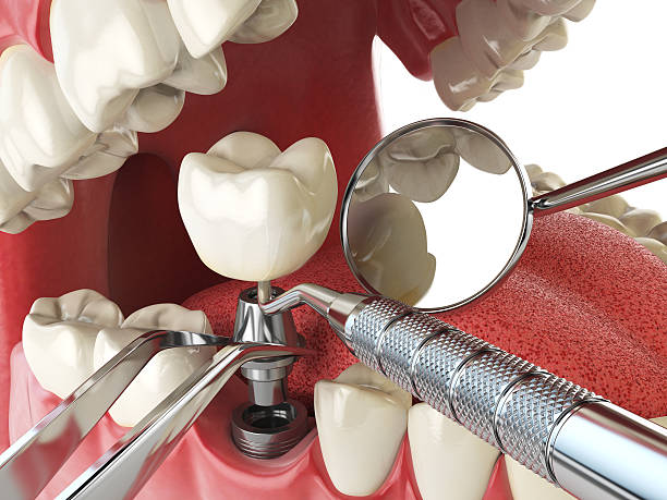 Best Emergency Dental Care for Sports Injuries in Fredonia, KS